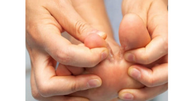 Hình ảnh bệnh nấm kẽ chân