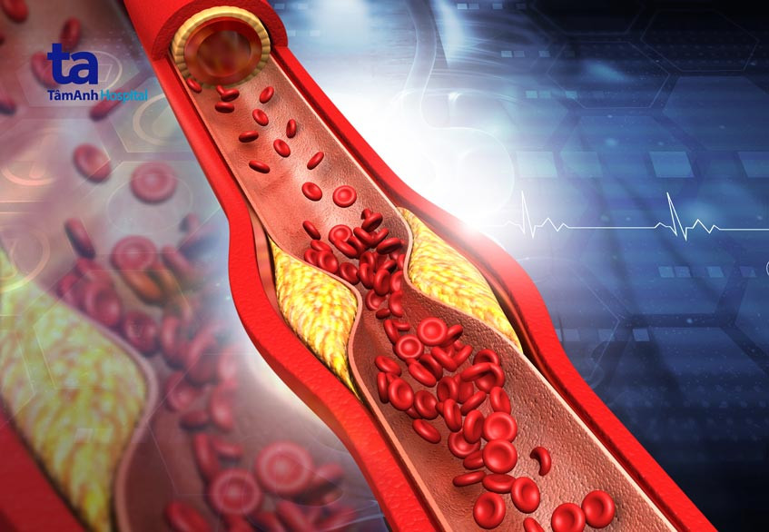 mức cholesterone ldl cao