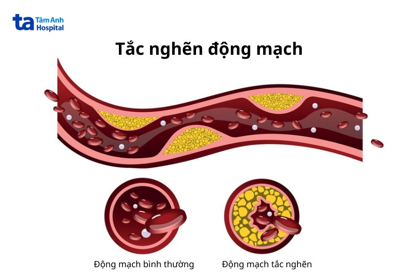 mỡ dưới da làm tắc nghẽn động mạch